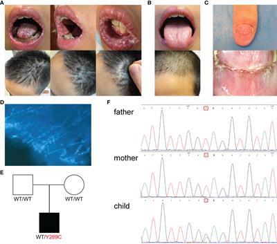 Single-cell RNA sequencing combined with whole exome sequencing reveals the landscape of the immune pathogenic response to chronic mucocutaneous candidiasis with STAT1 GOF mutation